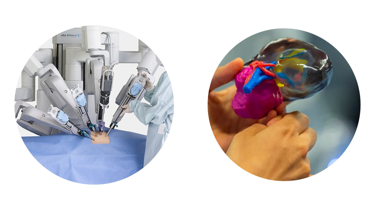 Traitements chirurgicaux des tumeurs du rein (chirurgie robotique, impression 3D)